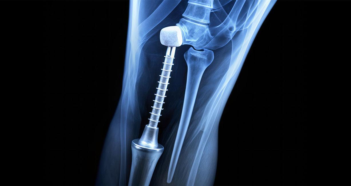 Impact of PFAS Regulations in Medical Devices