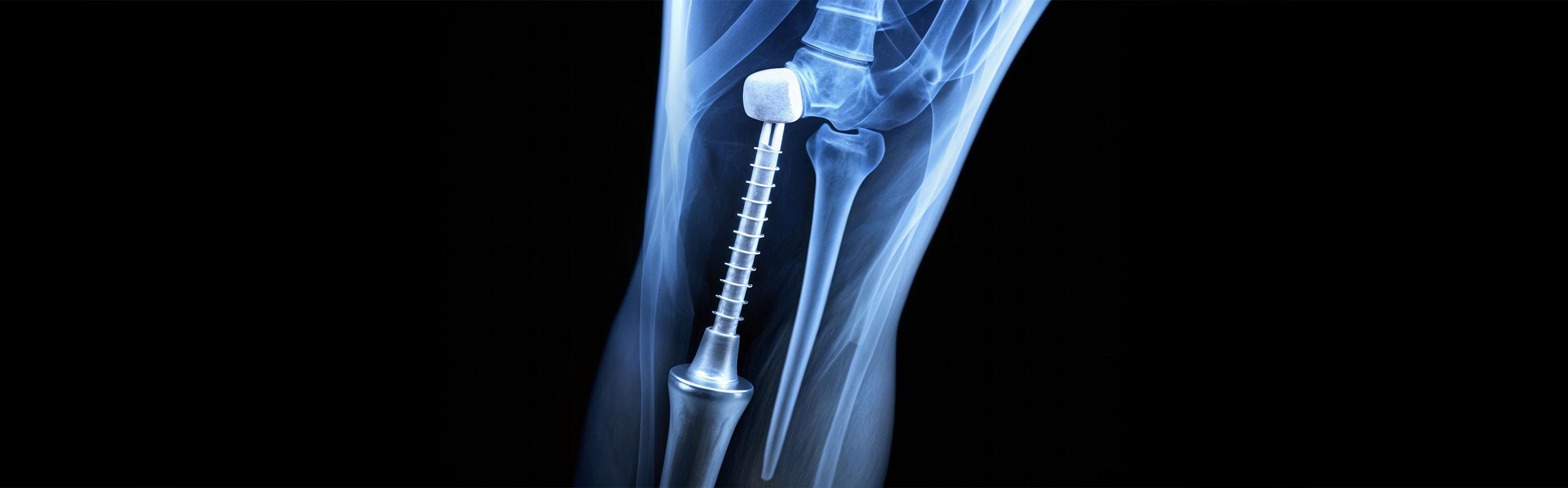 Impact of PFAS Regulations in Medical Devices